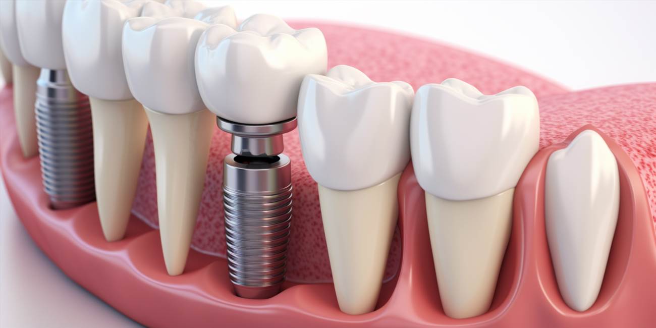Protezy zębowe na implantach